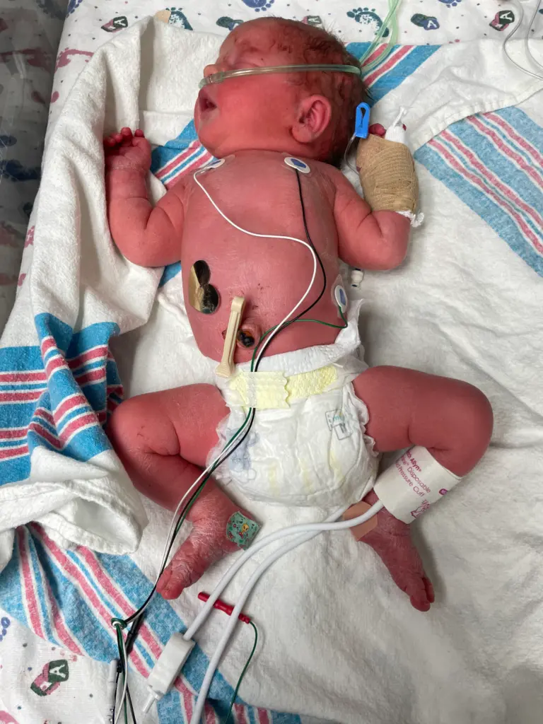 Too Late for the Hospital: My 37-Week Unplanned Home Birth and the Helicopter Ride to the NICU 3 Newborn Wrangler resting in a warmer, connected to a vital signs monitor. She is receiving oxygen via a nasal cannula and still has visible dried blood from her home birth.
